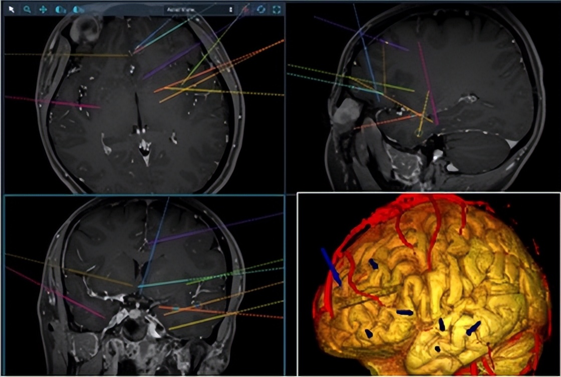 科普癫痫知识关爱癫痫患者,世界癫痫防治日