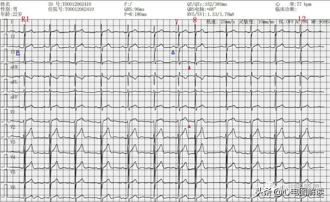 房性早搏二联律的解释,房性早搏二联律正常吗