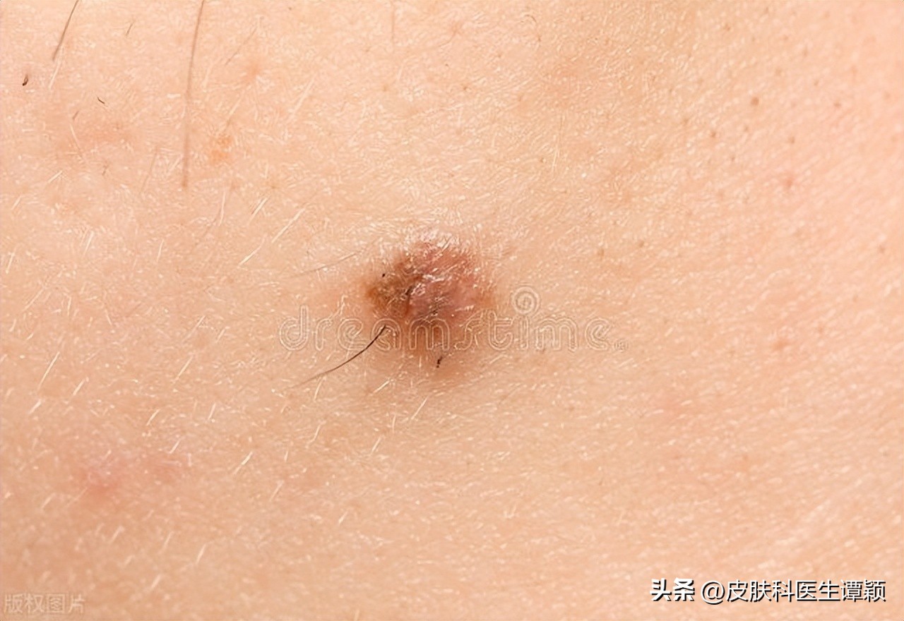 医院皮肤科医生谈痣,皮肤科色素痣科普