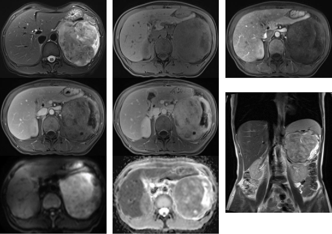 腹膜梭形细胞瘤怎么治,腹腔梭形动脉瘤严重吗