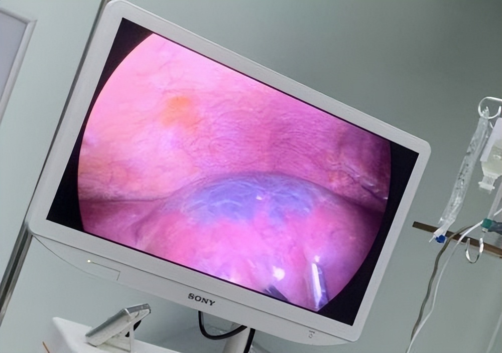 医生提醒大多数囊肿无需处理,请问囊肿有什么需要注意的吗