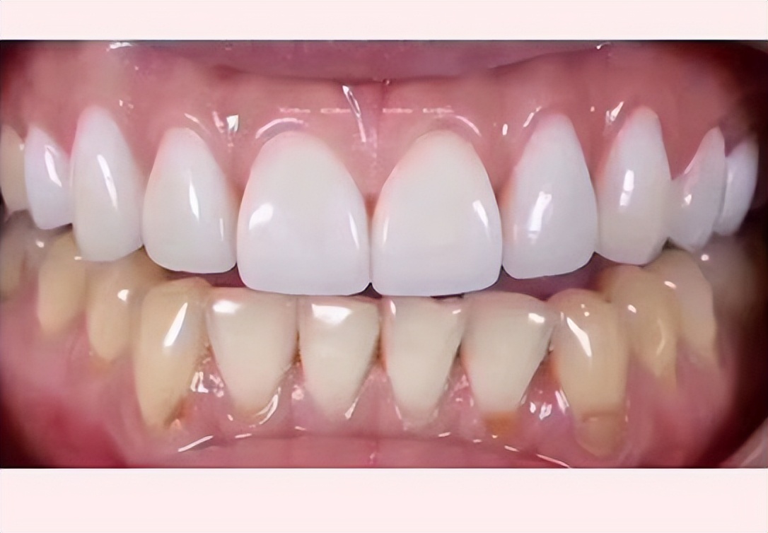 牙齿贴面属于美白还是修复,什么是牙齿贴面