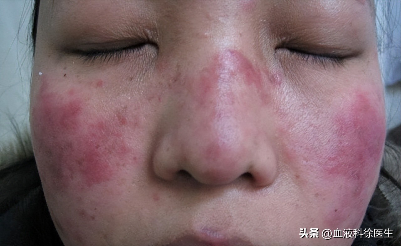 老年人白细胞高16严重吗,老年人白细胞20以上严重吗