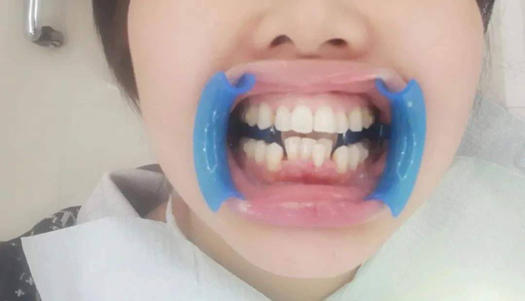 整牙亲身经历分享一下,整牙的经历分享