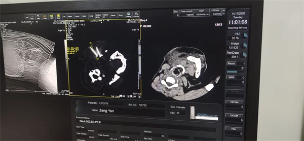 粒子和放疗：广药三院肿瘤科一区精度越高疗效越好