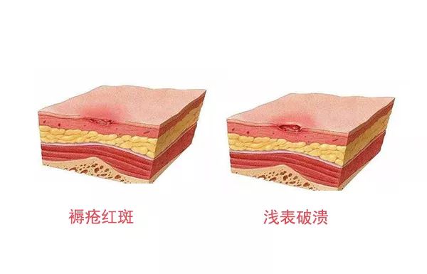 褥疮的早期症状,褥疮最早期是什么症状