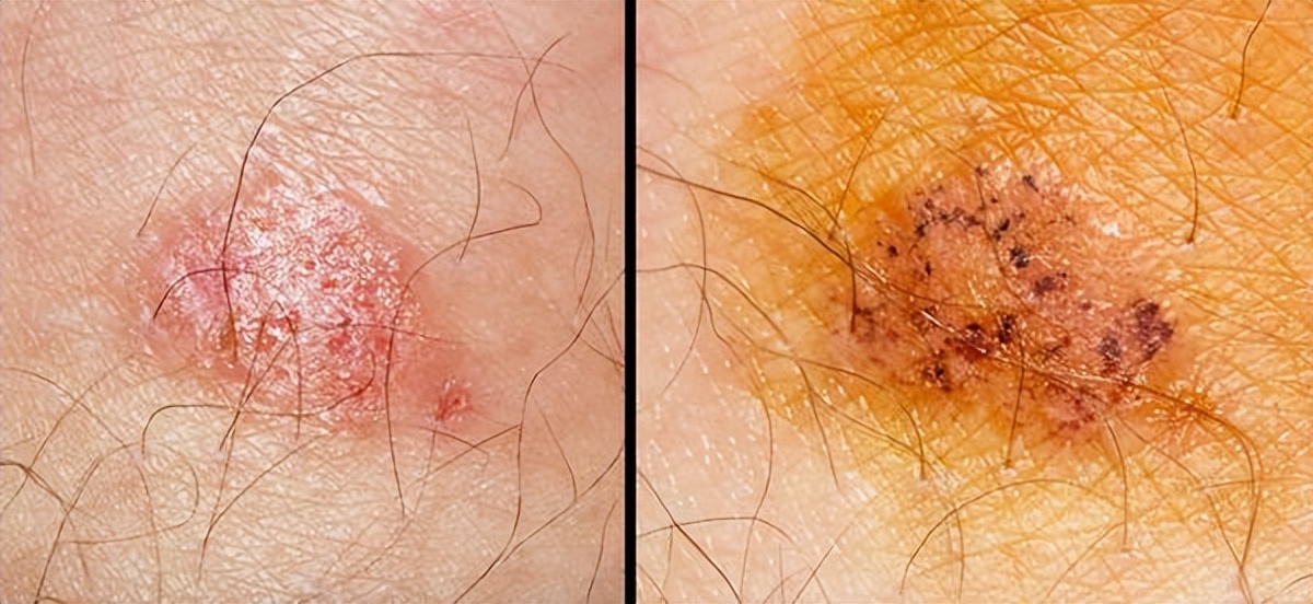 糖尿病患者手术伤口怎样恢复得快,糖尿病患者伤口愈合饮食