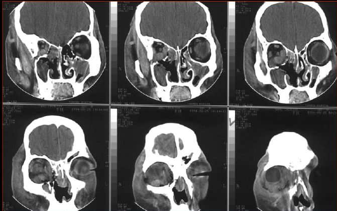 儿童鼻窦炎的诊治策略,儿童鼻窦炎的症状和最佳疗法