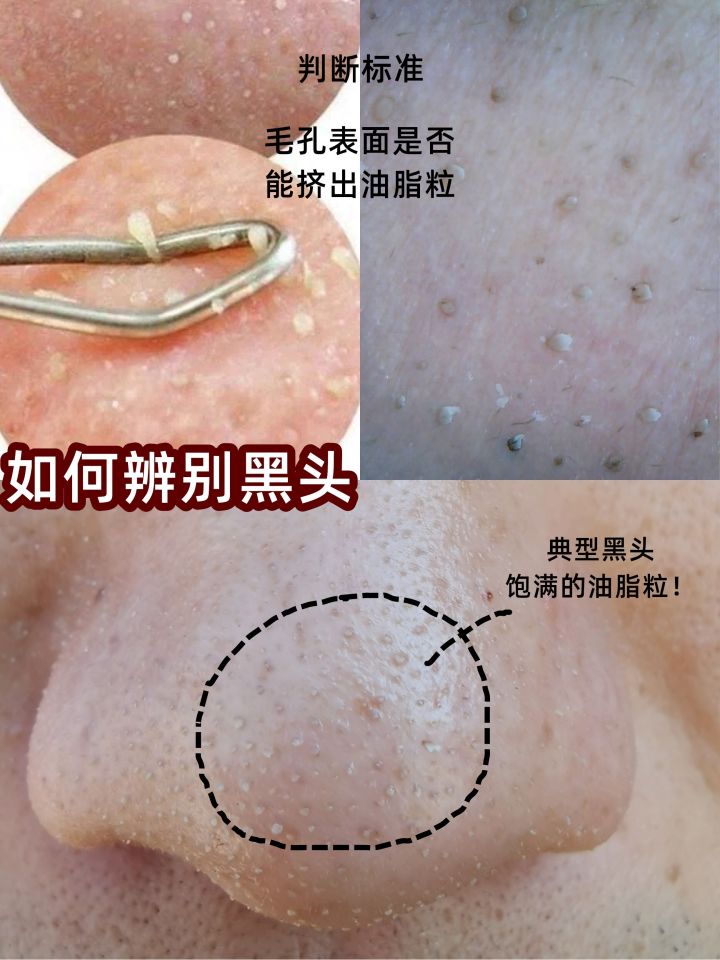 鼻子上的黑头会长毛么,鼻子上的黑头会蔓延到脸上吗