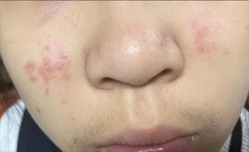 面部皮炎是炎症吗,脂溢性皮炎面部痒