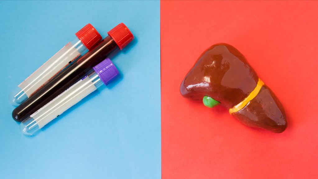 体检总胆红素偏高是肝病吗,肝病患者胆红素升高说明什么