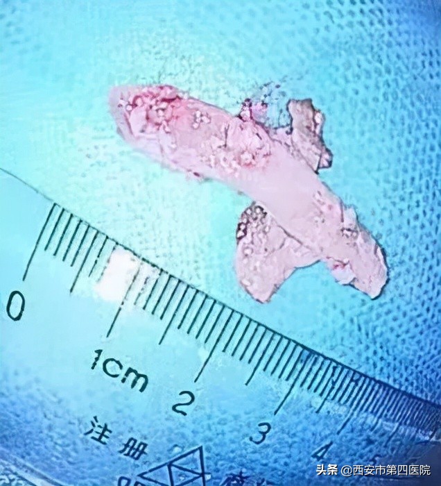 #健康中国行动2030#【吃鸡有风险！六旬老人不慎将4cm鸡骨头卡在喉咙】