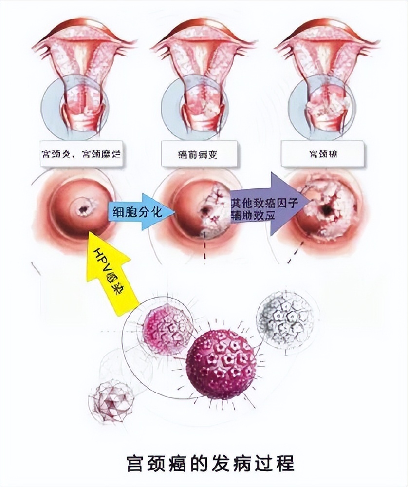 感染hpv导致宫颈癌还能治好吗,感染hpv导致癌变的几率