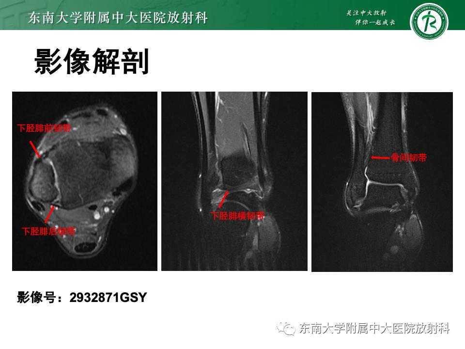左腓骨下段骨折伴下胫腓联合分离,好文分享深度揭秘