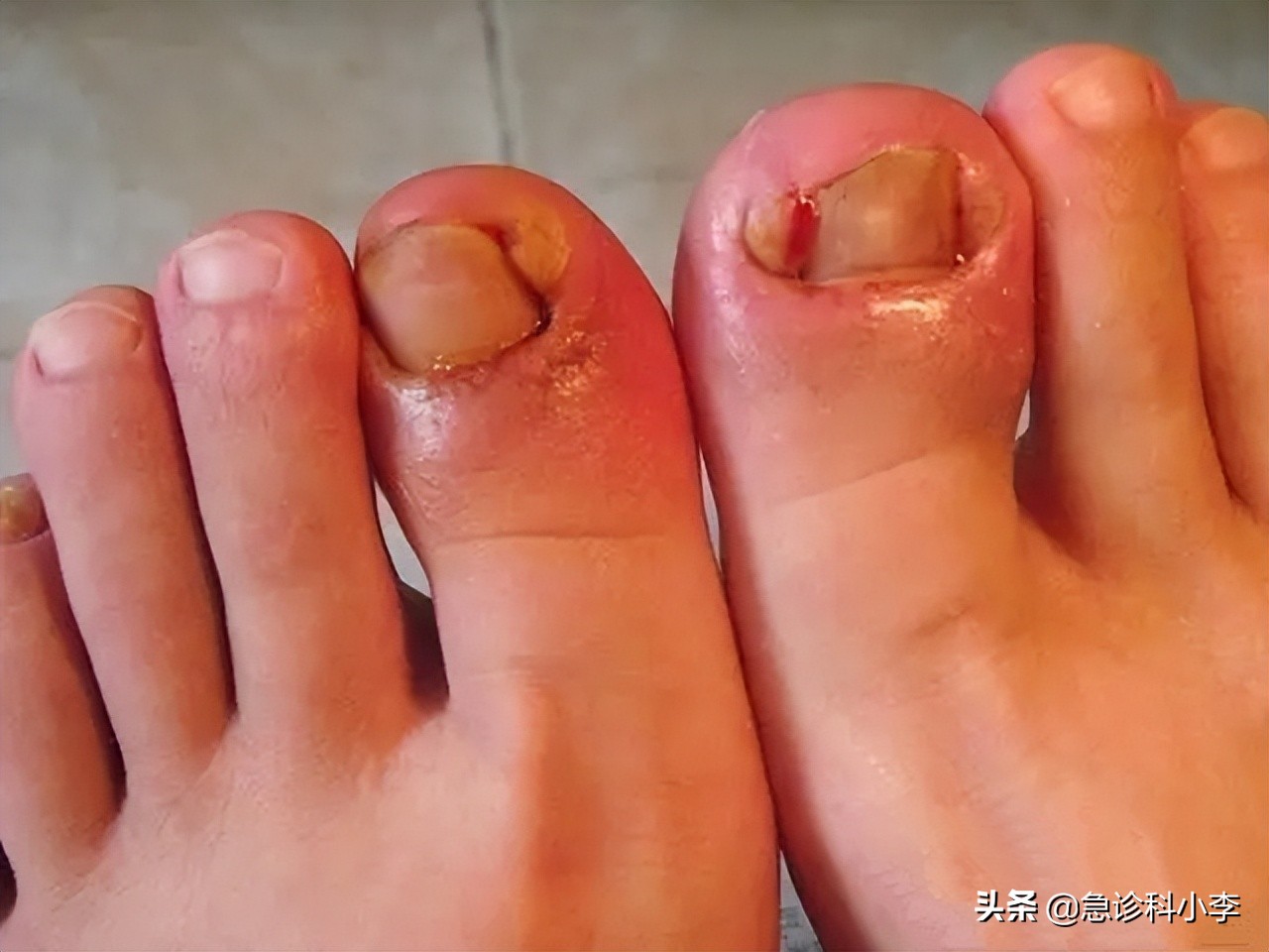 脚趾甲老往肉里长怎么办,甲沟炎脚趾甲往两旁长怎么办