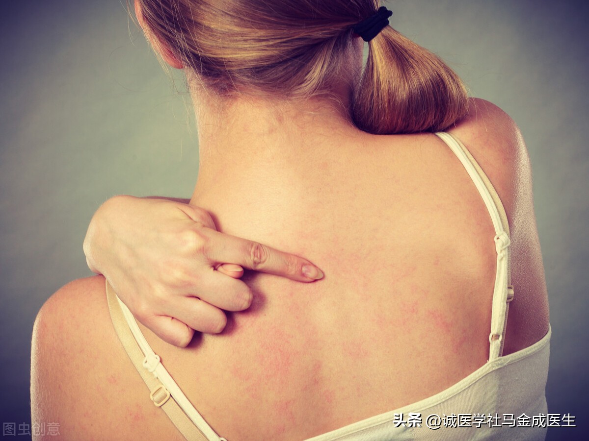 见风就痒用什么药,消风散能治哪些皮肤瘙痒病