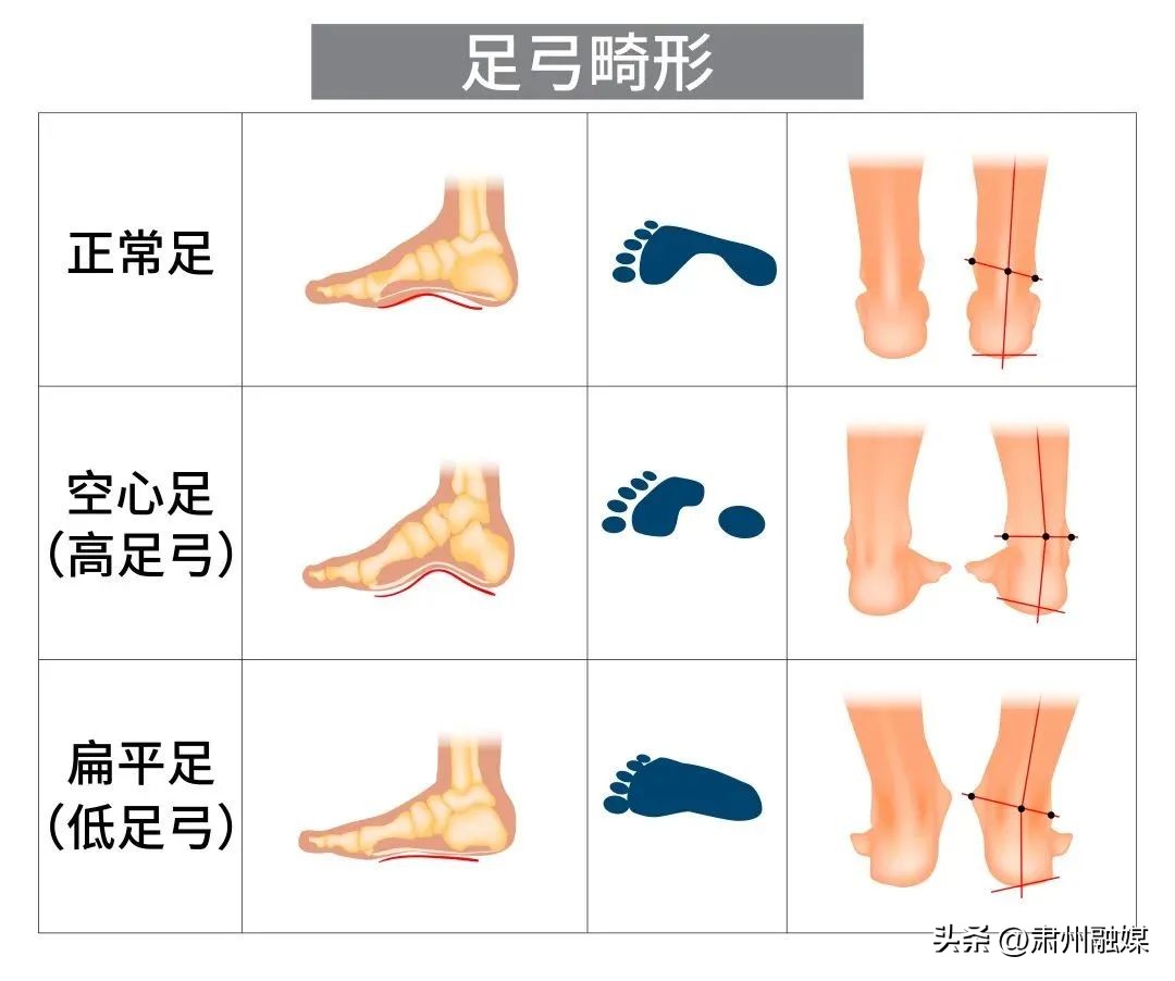 为什么现在的鞋越来越磨脚,原来合适的鞋穿久了也会磨脚