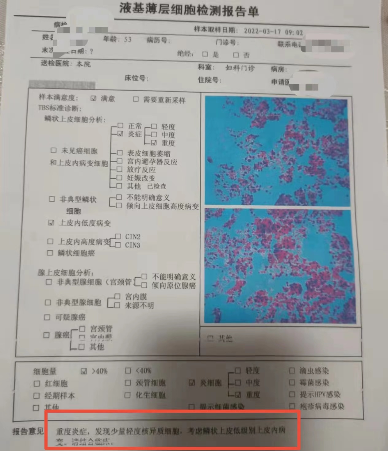 宫颈癌的4个常识,宫颈癌很可怕三个步骤教你预防