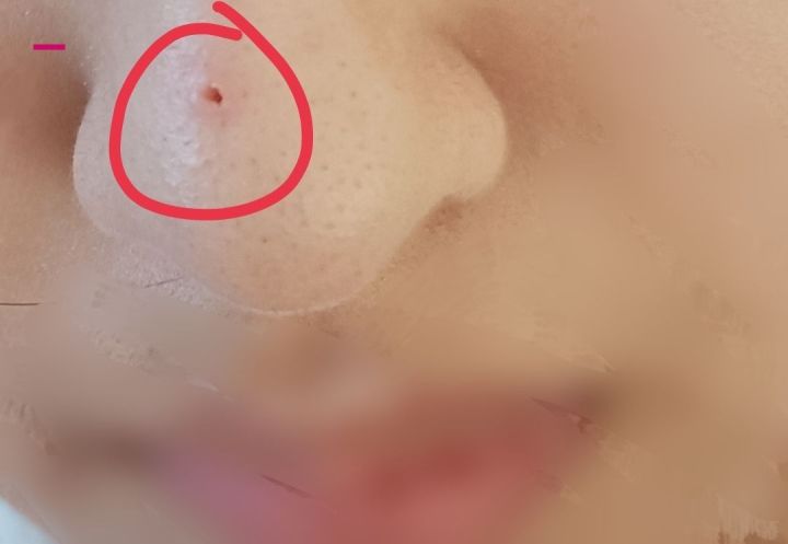 为什么鼻子可以挤出很大的黑头,用夹子挤出鼻子黑头