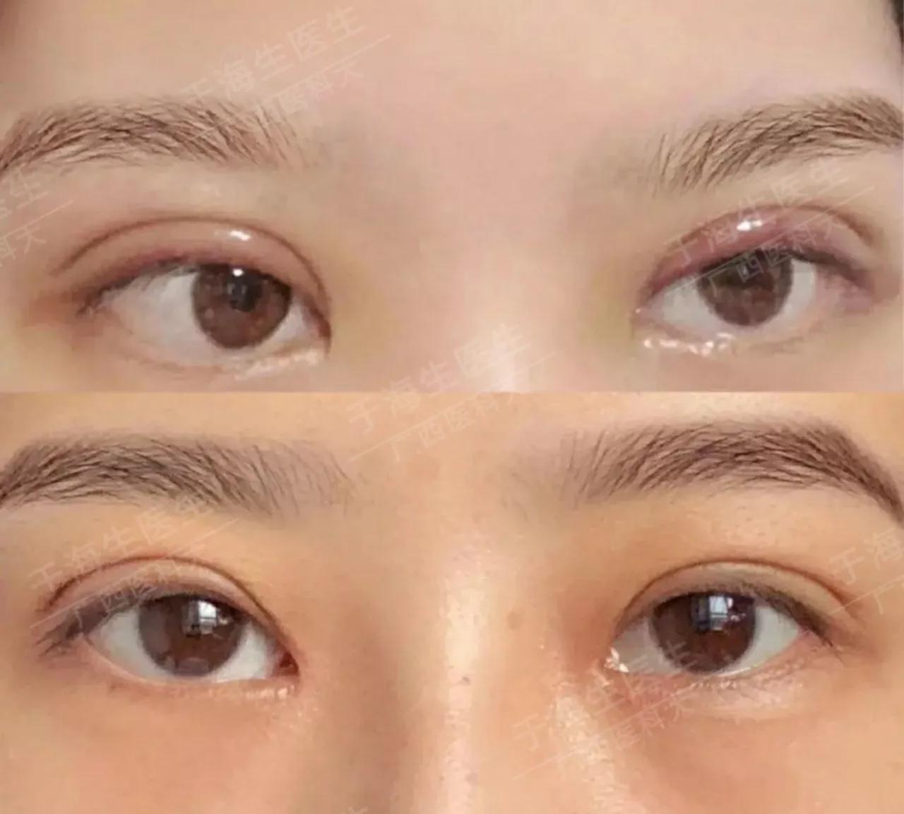 现在双眼皮修复都是什么手法,双眼皮修复怎么样才最好看