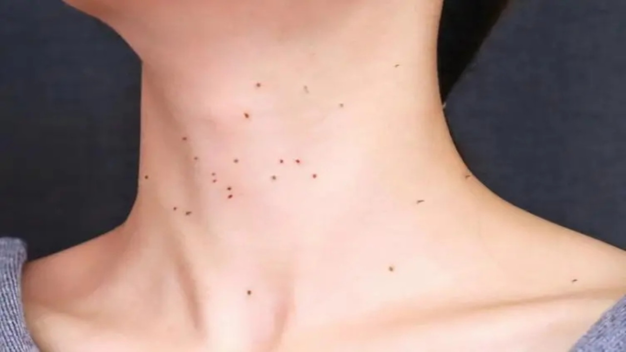 脸上、颈部、腋下的“肉疙瘩”是如何产生的？能用手抠掉吗？