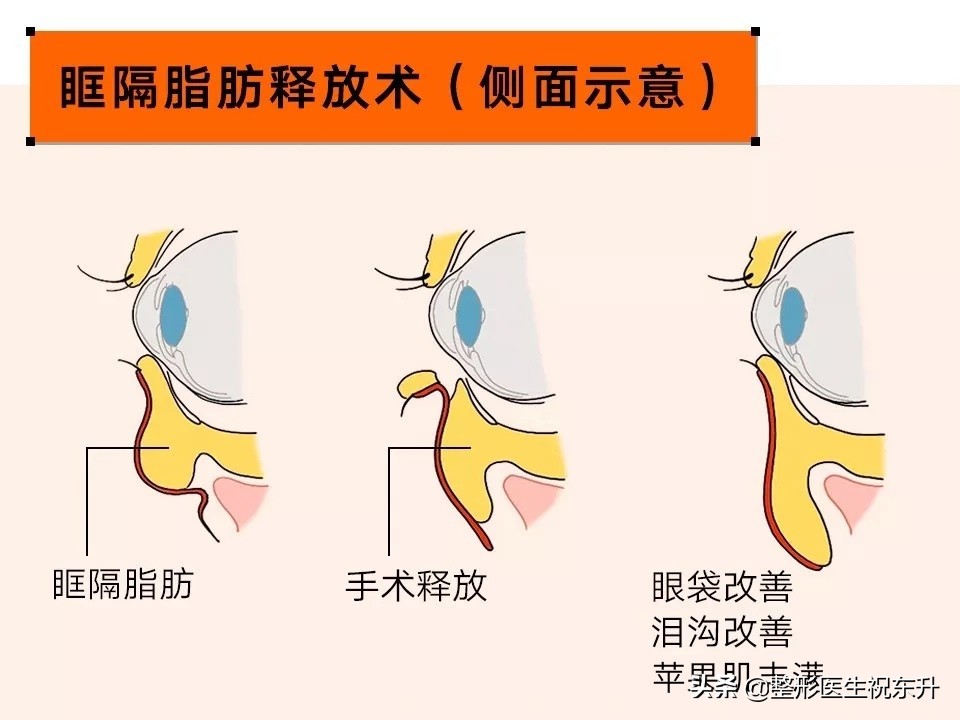 做眼袋手术后的真实经历,去眼袋外切手术26天亲身经历日记
