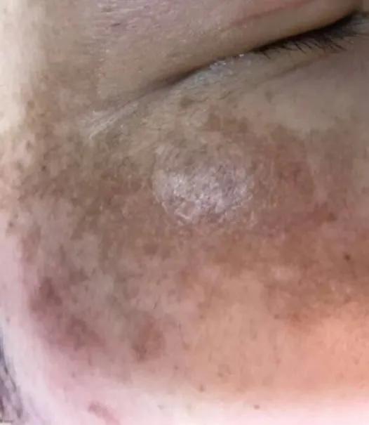 色斑怎么分辨,色斑的种类及鉴别诊断