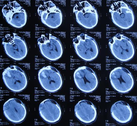 脑外伤后硬膜下积液颅骨修补,颅骨修复手术失败导致脑积水