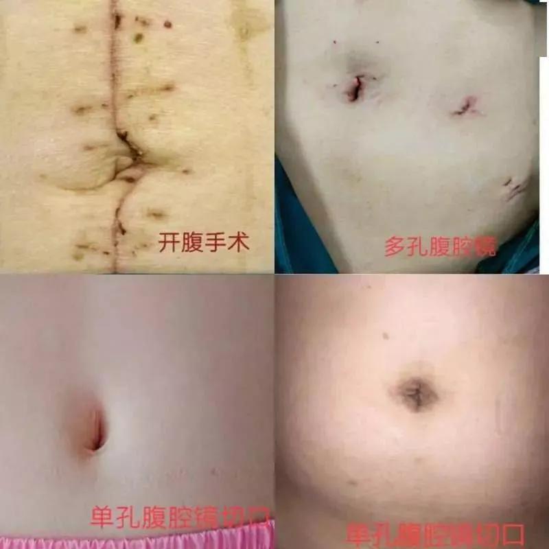 实体瘤多大需要做手术,有个小粉瘤必须做手术吗