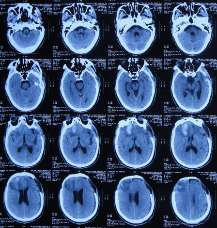 脑外伤后硬膜下积液颅骨修补,颅骨修复手术失败导致脑积水