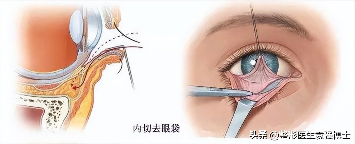祛眼袋手术的真相,眼袋去除手术真实案例