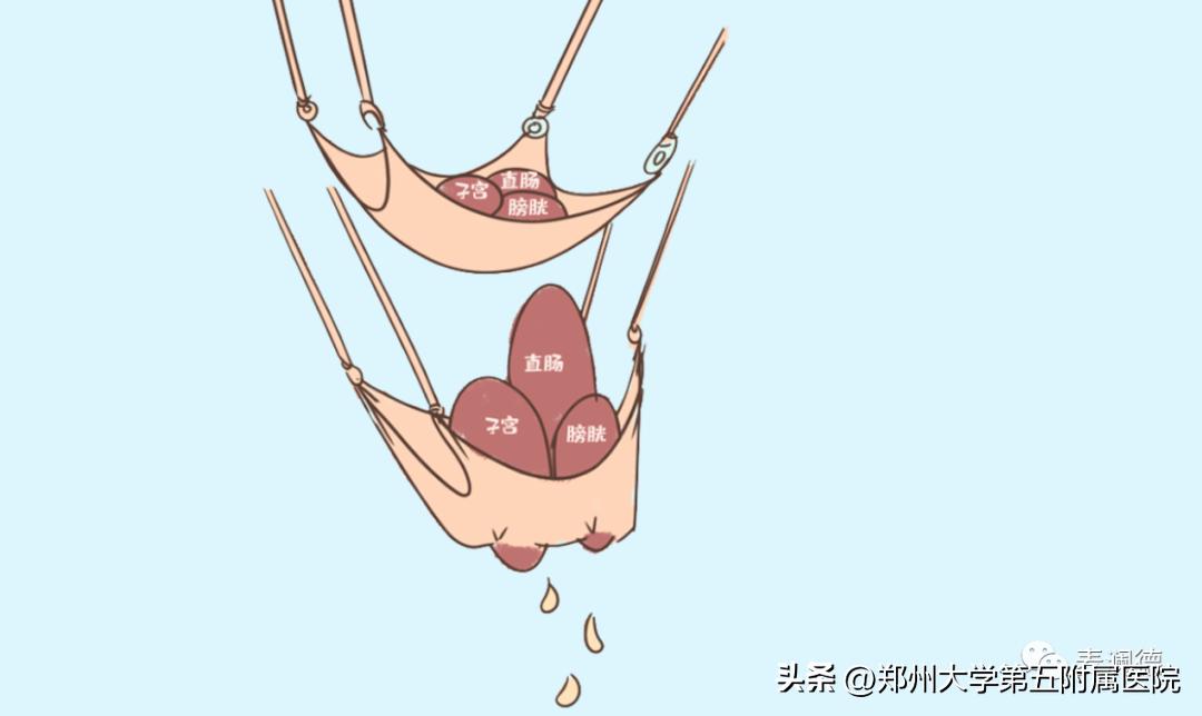 剖宫产盆底肌修复有必要做吗,剖宫产后恢复盆底肌腹直肌