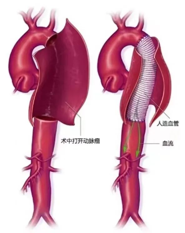 男子腹部剧痛检查意外肿瘤,男子腹痛难忍医生实施手术