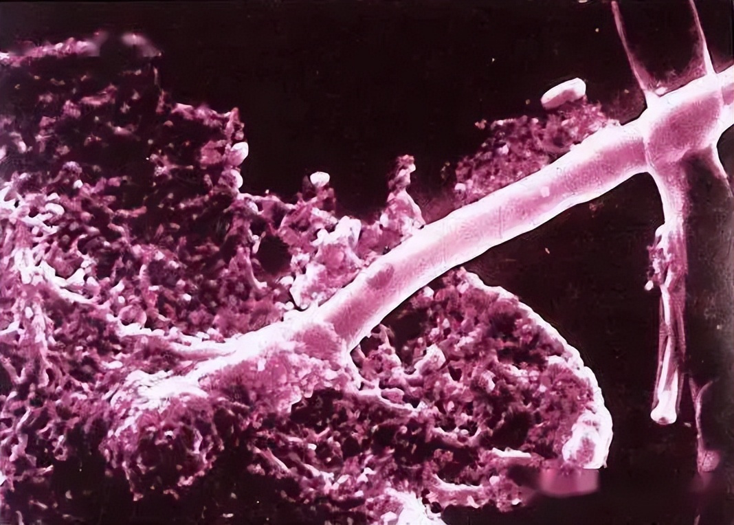 皮肤念珠菌病是什么症状,皮肤念珠菌病传染吗