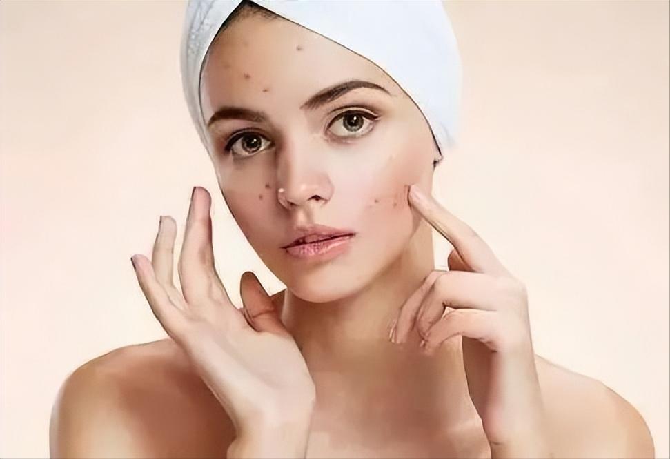 脸上长痘疮怎么去掉小妙招,脸上长痘疮的快速解决方法