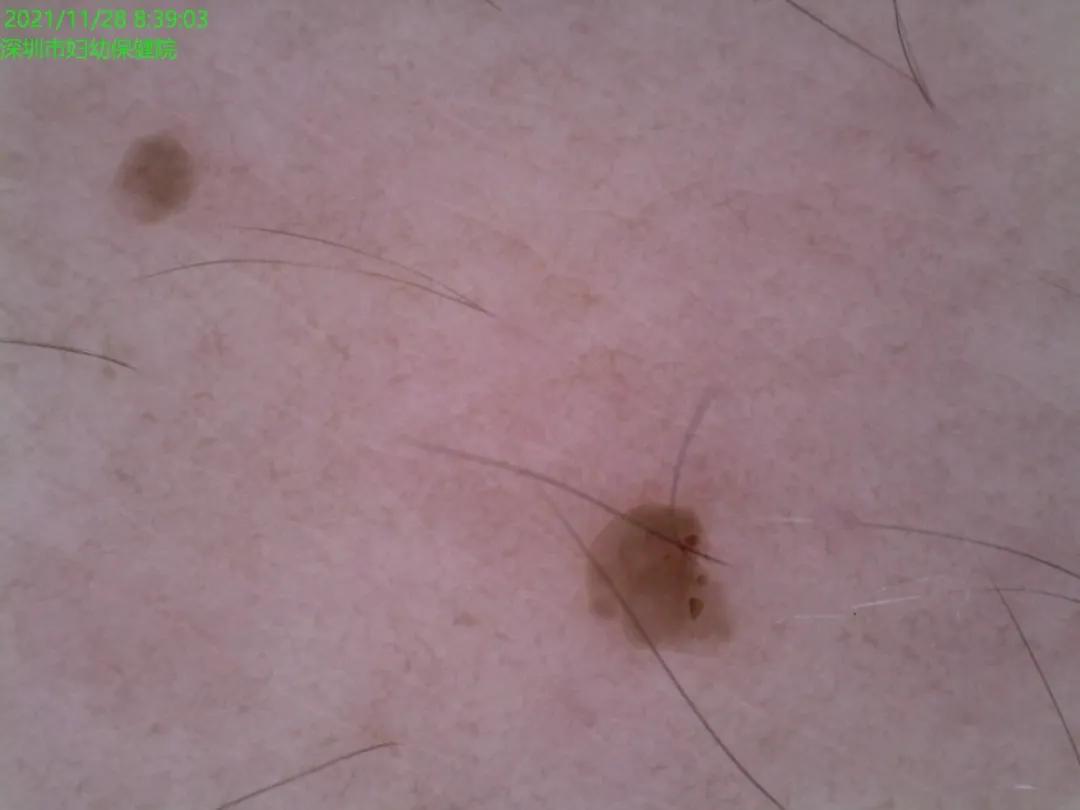 怀孕后脖子、身上长满了一粒粒小疙瘩，会传染吗？