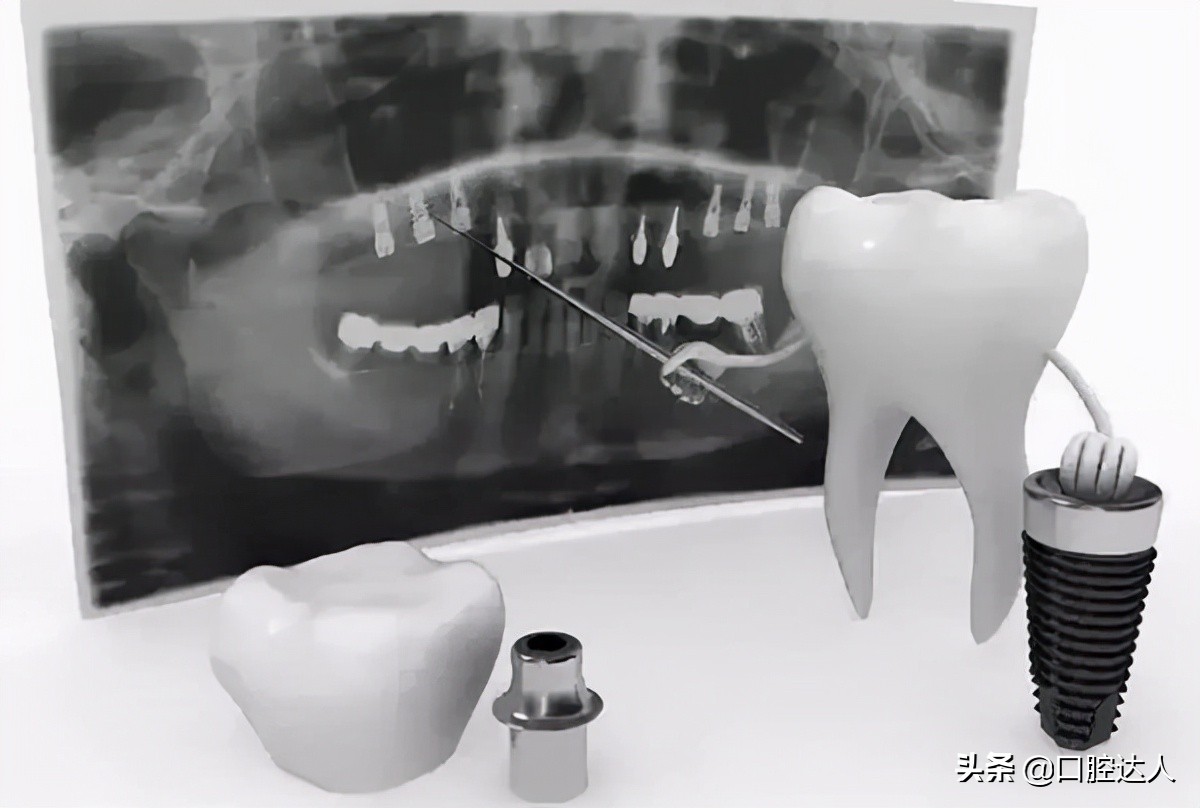 种植牙的流程分多少期,种植牙的过程包含哪些流程