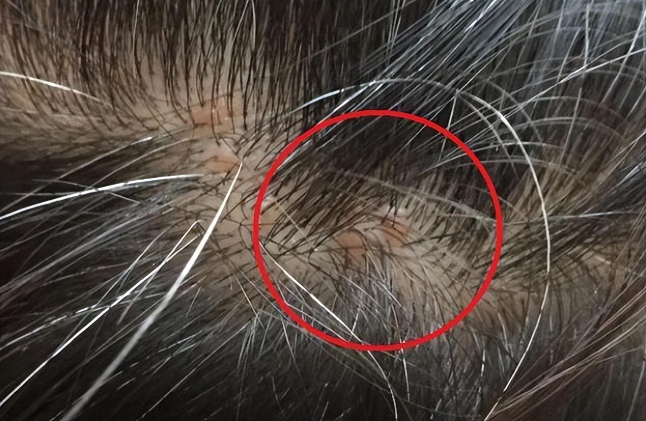 头皮上长疙瘩和脓包怎么治,头皮上总是长疙瘩和脓包如何根治