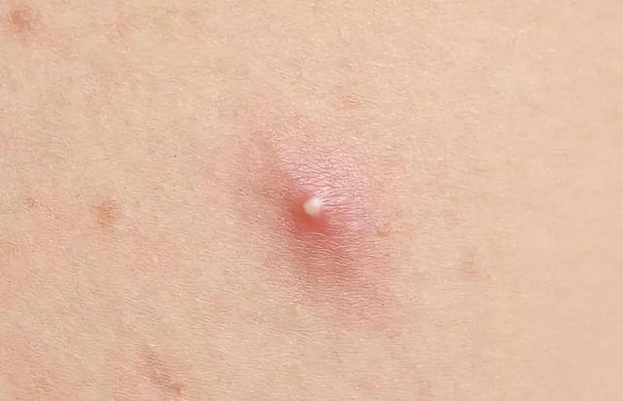 皮肤上长出肉疙瘩怎么办,皮肤上长肉疙瘩如何正确解决