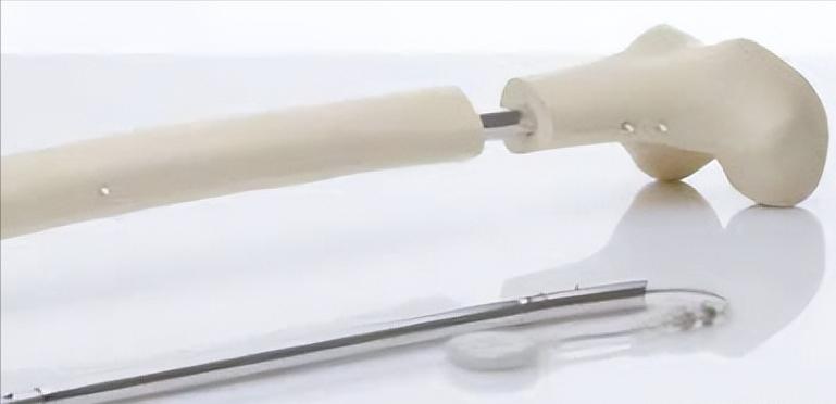 德国断骨增高20厘米,德国最新断骨增高术