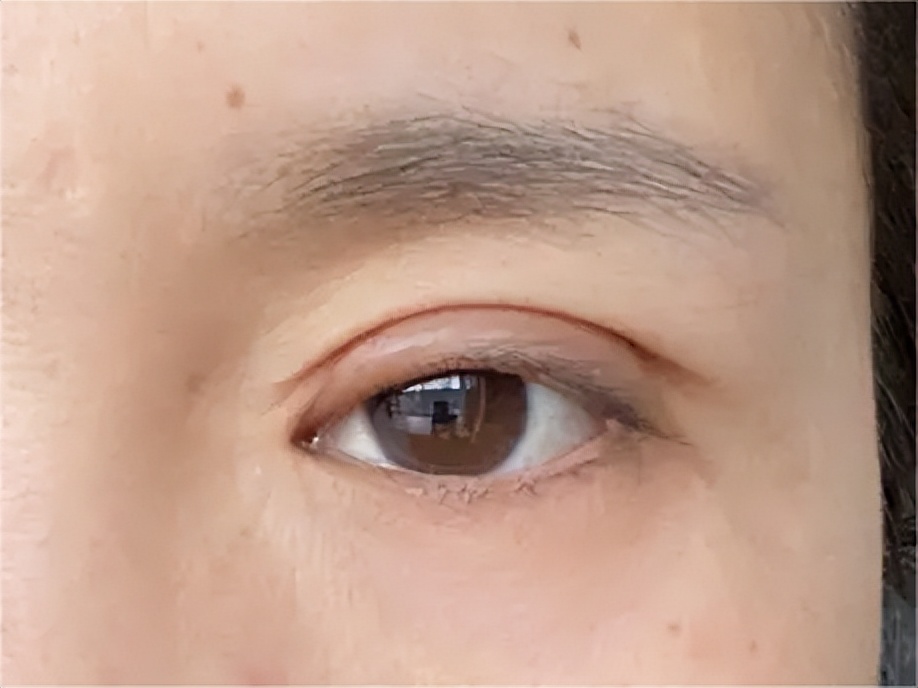 双眼皮手术后眼睛淤紫怎么消除,双眼皮术后眼头紧绷有细纹