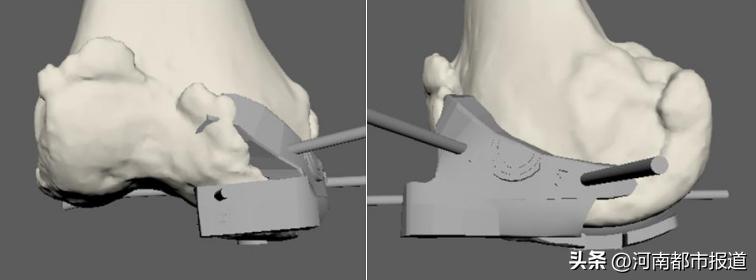 全球首例3d打印距骨表面假体置换,首例医生3d打印距骨表面植入人体