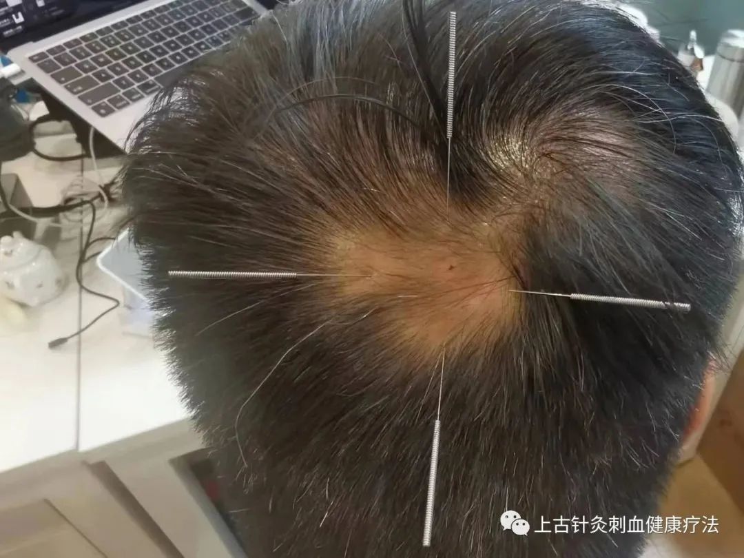 董氏奇穴治疗斑秃针灸特效穴,董氏五虎穴治疗腱鞘炎