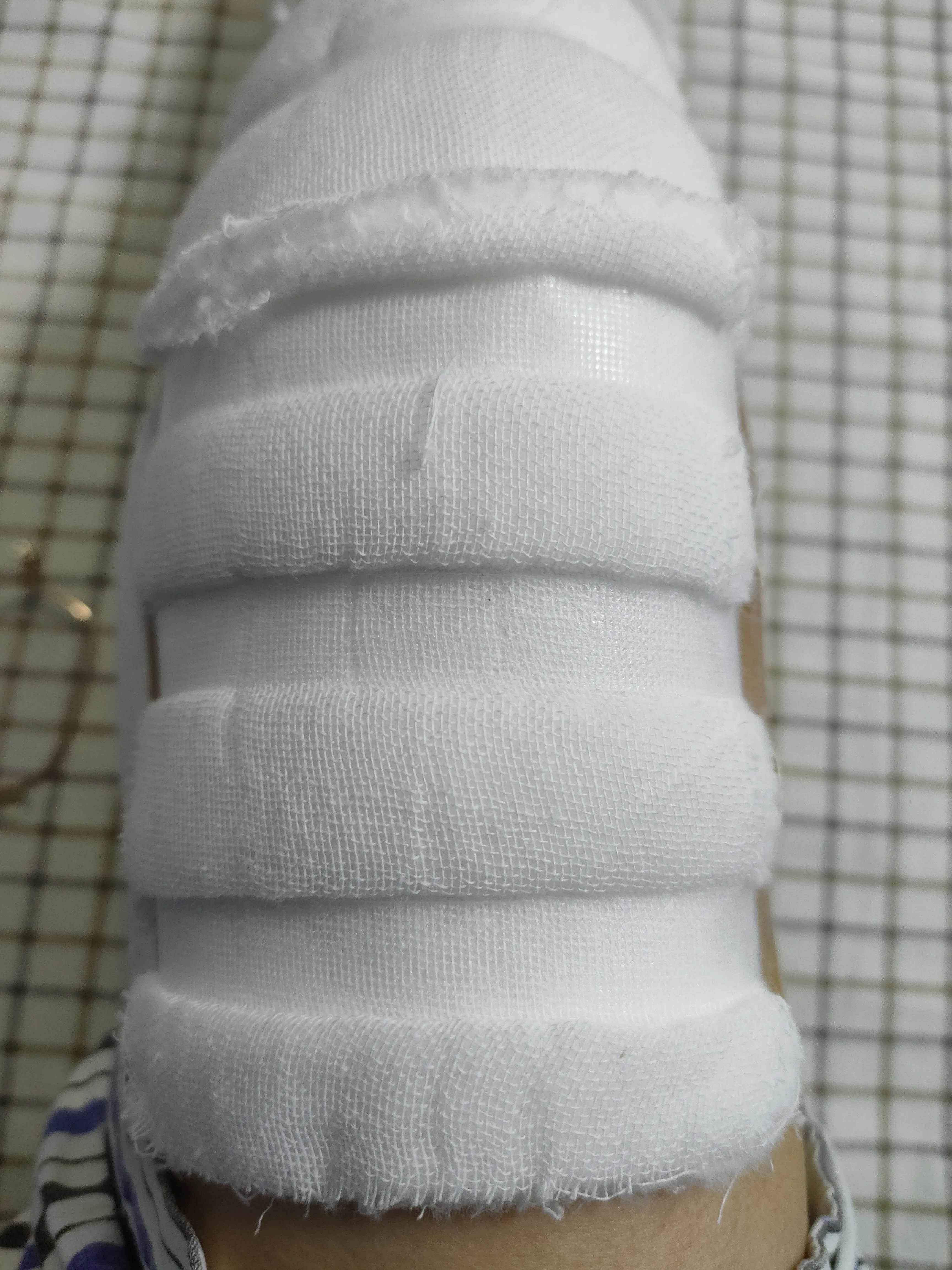 人工膝关节置换手术过程要多久,人工膝关节置换术后三个月