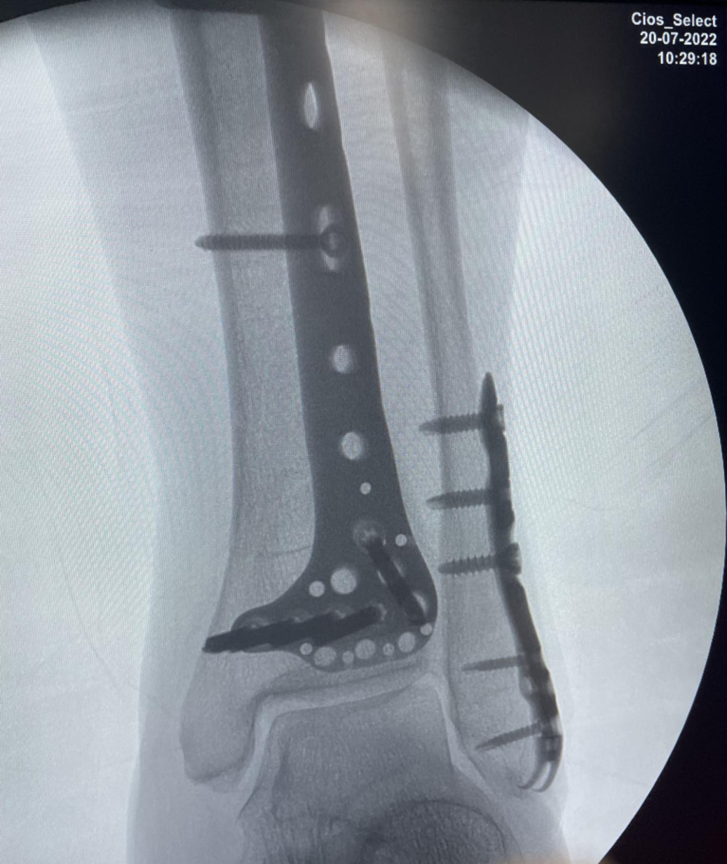 六旬大娘摔倒骨折,七旬老太太下公交车摔伤