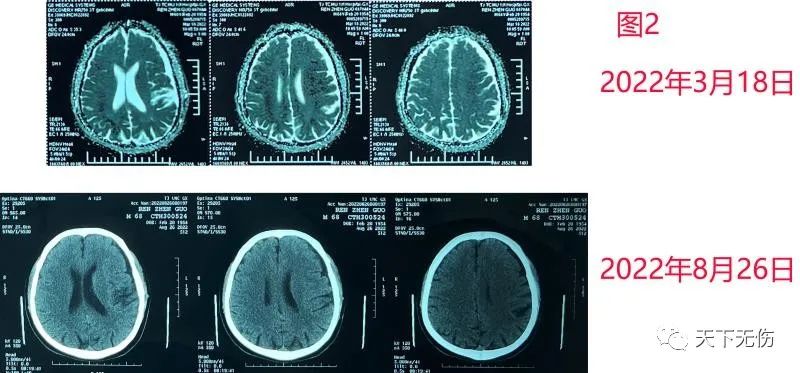 颈部淋巴结血肿,90多岁老人硬膜下血肿引流手术