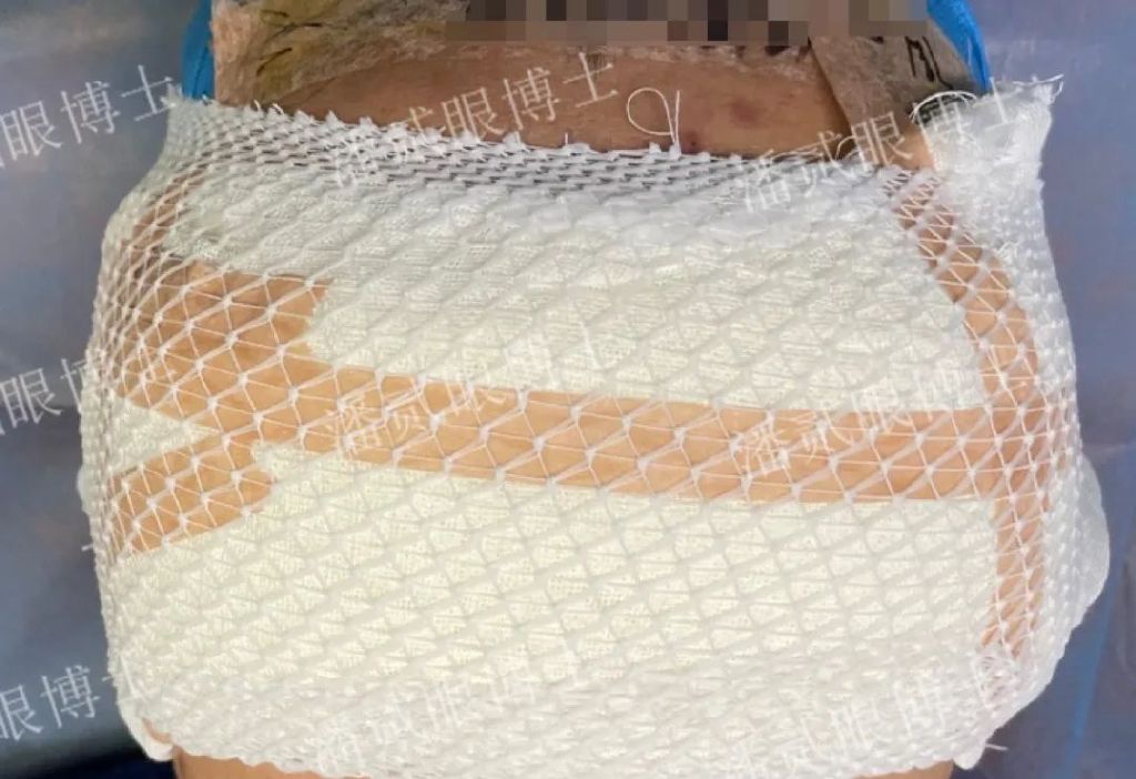 术后（重度上睑下垂）出现结膜脱垂怎么办？