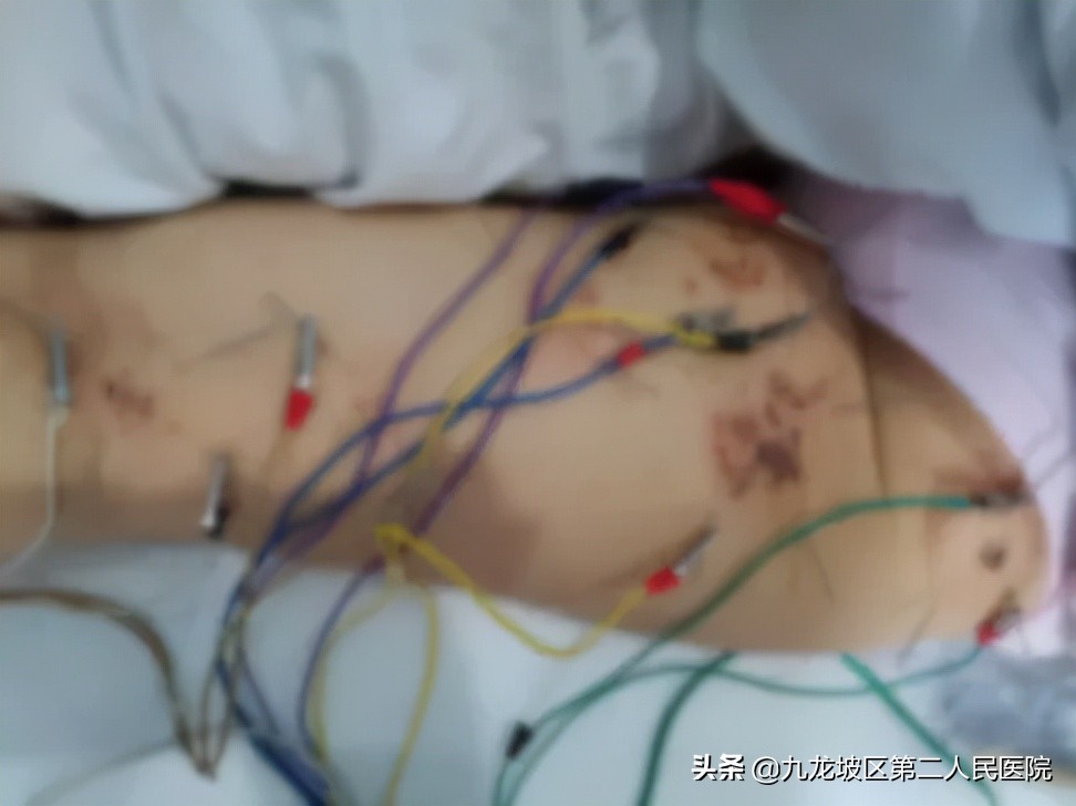 58岁阿姨臀部长疱疹，医生用火针放血、隔物灸疗居然治好