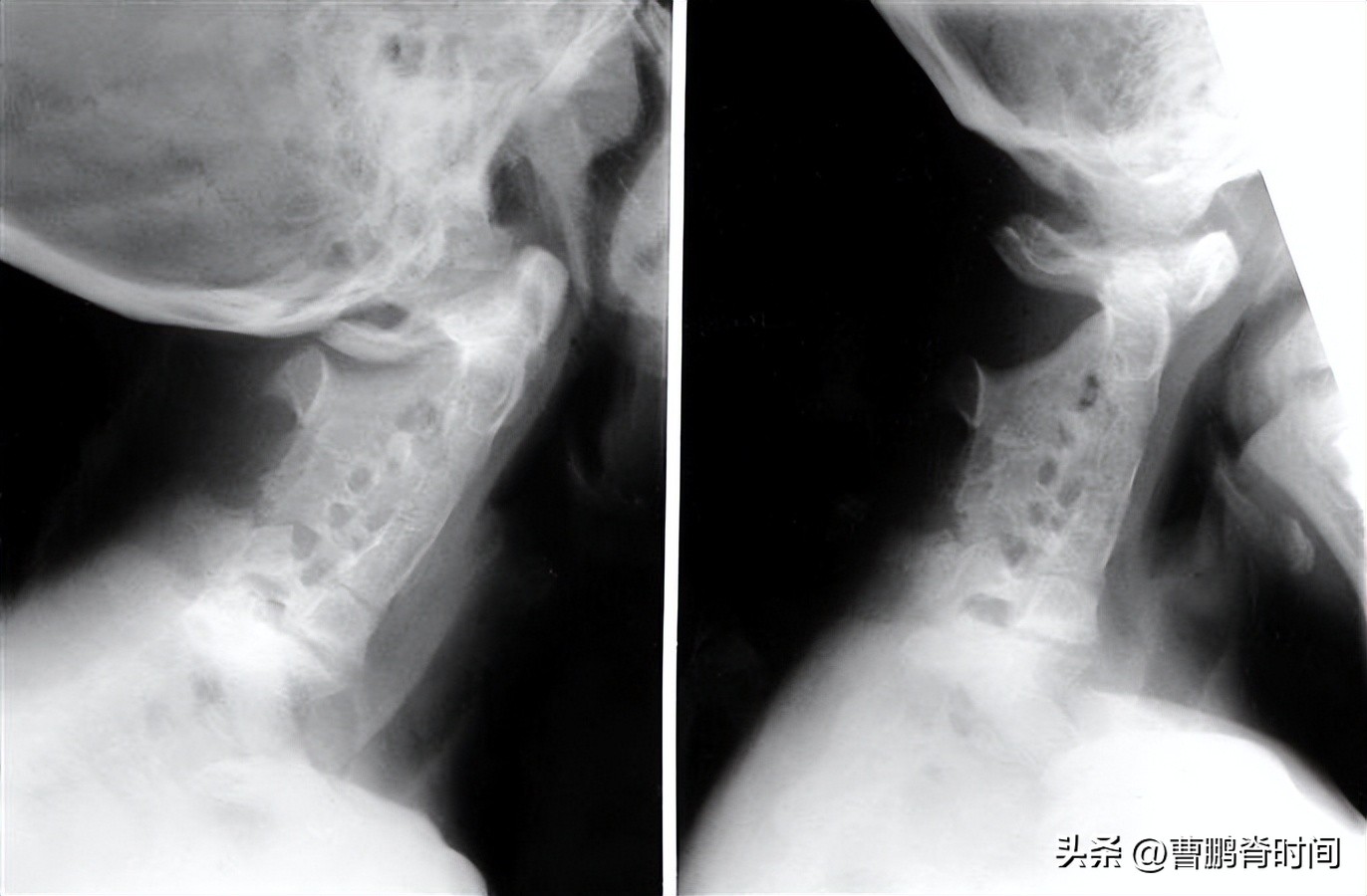 脖子两侧筋痛要警惕三种疾病,天生短脖子怎么改善
