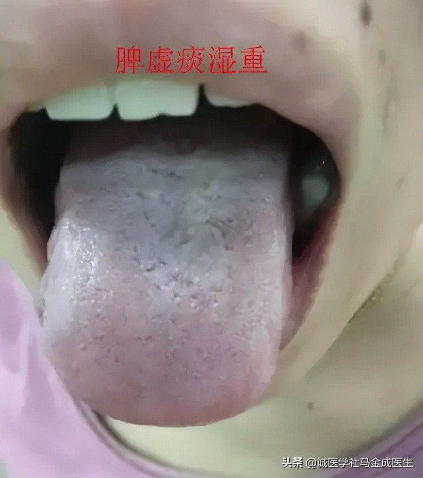 一补就上火的人怎么调理,舌苔上火怎么调理